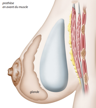 protheses-mammaires-1