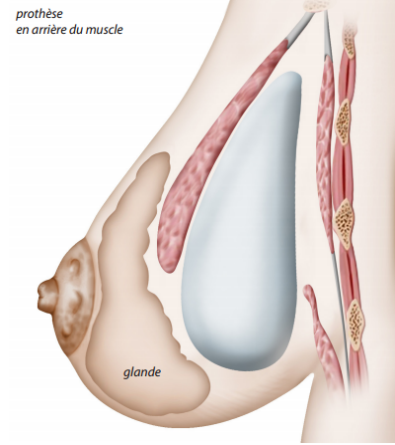 Prothèses mammaires-2